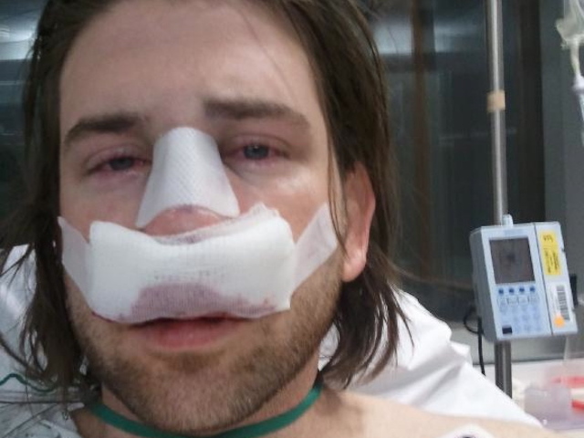 Robert Demartini is suing the owner of Lace Gentlemen's Club, accusing club security of punching him in his nose without provocation.
