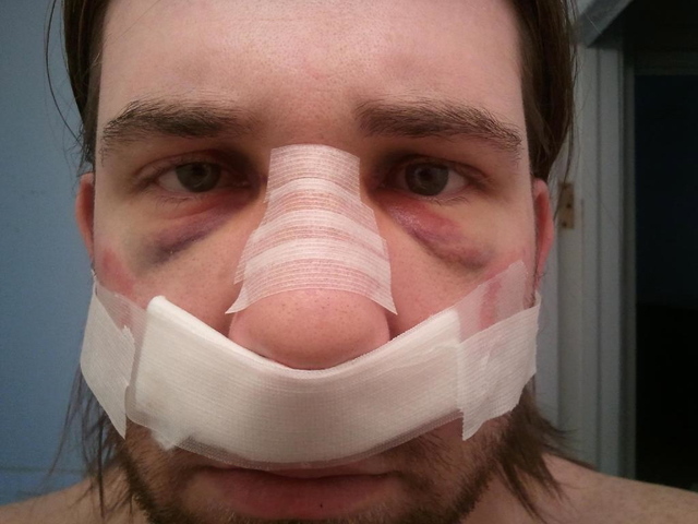Robert Demartini is suing the owner of Lace Gentlemen's Club, accusing club security of punching him in his nose without provocation.