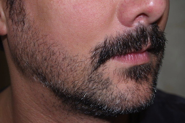  More New Yorkers with depleted beards are getting surgical facial hair procedures, doctors told DNAinfo New York. 
