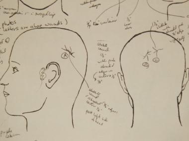An autopsy drawing of Linda Stein's skull, which examiners believe was hit nearly two-dozen times with a blunt object.
